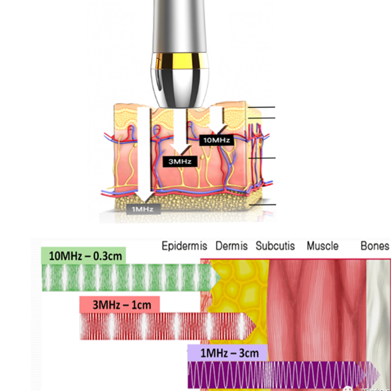 Yrityksen kehittämä 10 MHz Ultrasonic Beauty Instrument